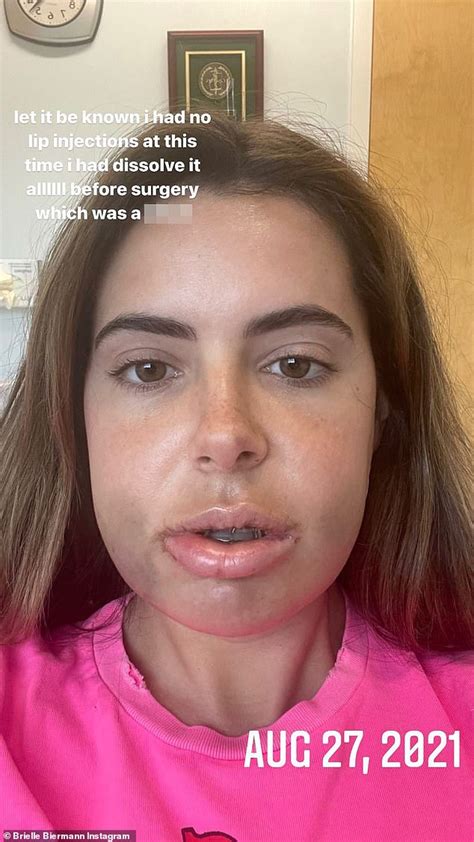 Brielle Biermann Had Lip Injections Dissolved Before Jaw Surgery Hot Lifestyle News