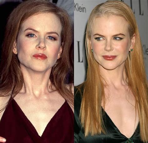 Chatter Busy Nicole Kidman Plastic Or Cosmetic Surgery