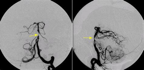 Basilar Artery Stenosis Lateral View