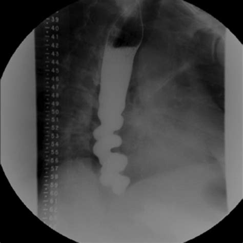 High Resolution Manometry Consistent With Distal Esophageal Spasm DL