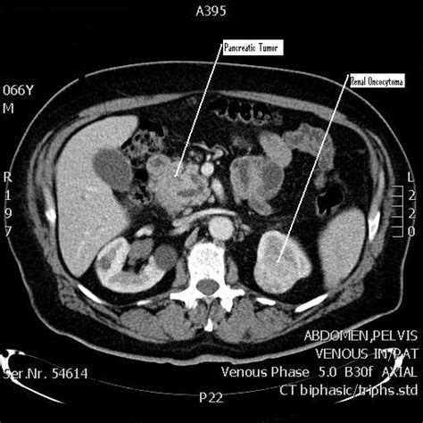 Ct Scan Of The Abdomen Showing The Pancreatic Tumor And Open I