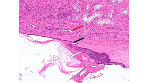 Cureus Bilateral Testicular Epidermoid Cysts In A Man With