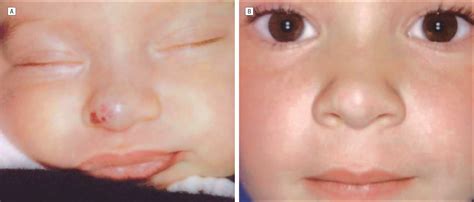 Management Of Nasal Hemangiomas Jama Facial Plastic Surgery The