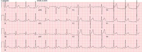 Dr Smiths Ecg Blog 31 Year Old Male With Ruq Pain And A History Of