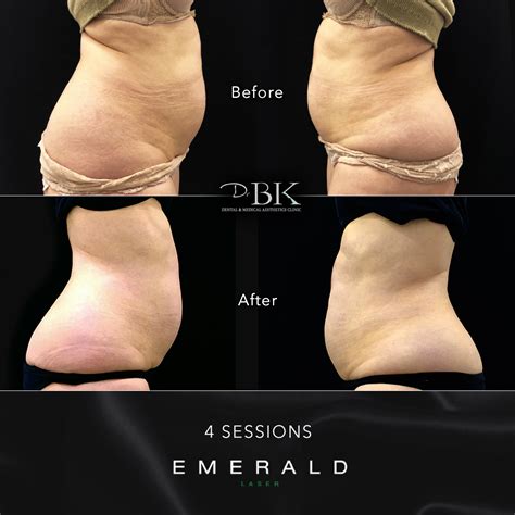 Emerald The Award Winning Fat Loss Laser Works Up To BMI