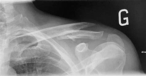 Fractured Collarbone Any Suggestions The Nine Hammers Tavern