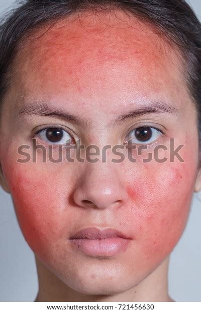 Face Young Woman Red Rash Skin库存照片721456630 Shutterstock
