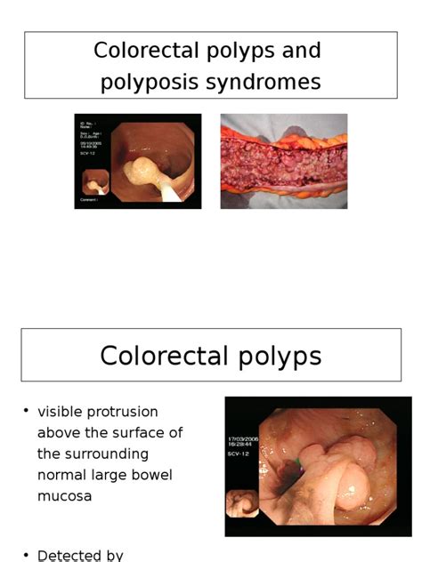 Polyps And Polyposis Adenoma Colorectal Cancer