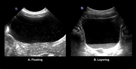 Urinary Tract Sonography Phantom Bladder Lesion Clinical Report My