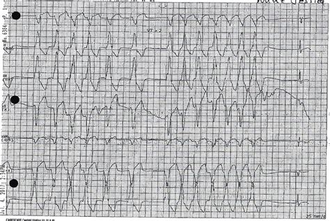 Less Phosphorus More Problems Hypophosphatemia Induced Polymorphic Ventricular Tachycardia In