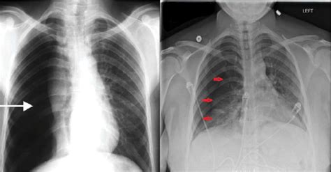 Chest X Ray Showing Large Right Pneumothorax With