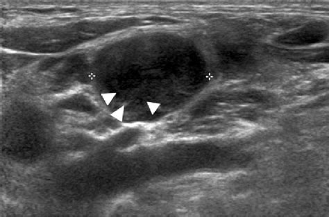 The Transverse Sonogram Of The Left Supraclavicular Region Shows An