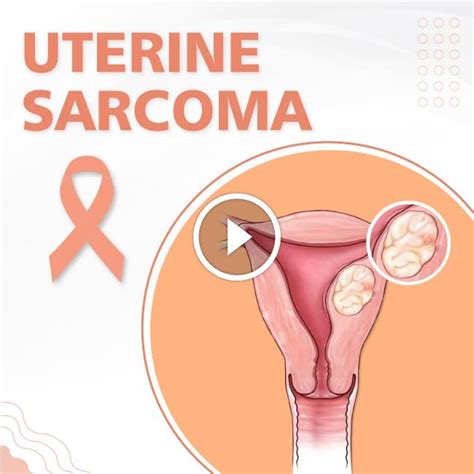Uterine Sarcoma Signs And Symptoms Uhapo