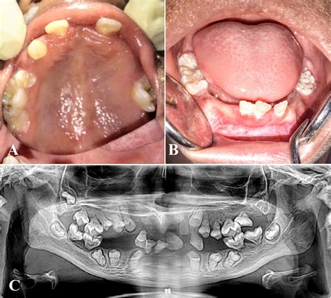 Microcephalic Osteodyplastic Primordial Dwarfism Type Ii Case Report