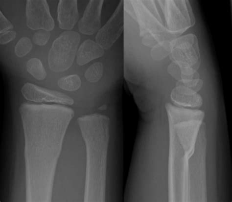 Torus Fracture Of The Distal Radial Metaphysis