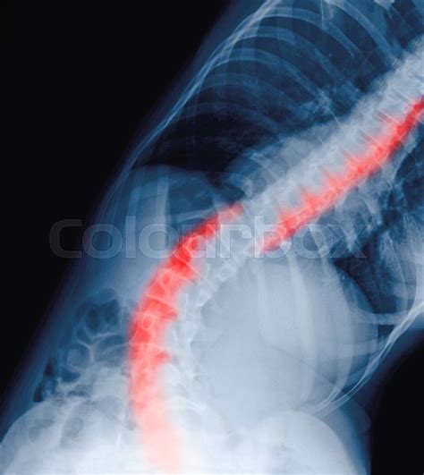 Scoliosis Film X Ray Show Spinal Bend In Teenager Patient Concept