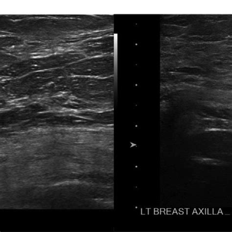 Static Representative Ultrasound Image Of The Left Breast Upper Outer