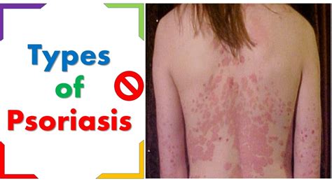 Types Of Psoriasis Or Psoriasis Types Youtube