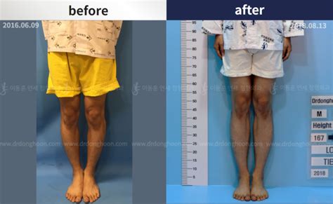 Cosmetic Leg Lengthening Surgery And Bowlegs Correction Limb