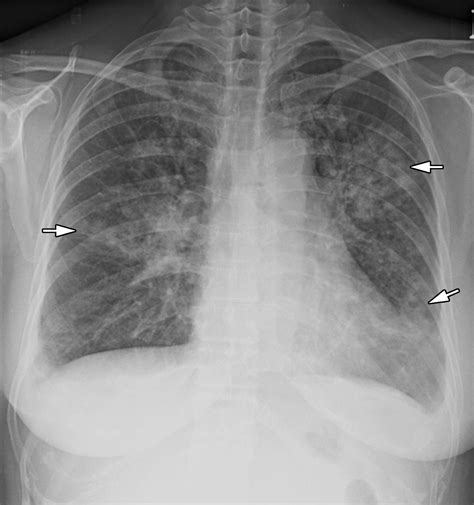 Radiographic And Ct Features Of Viral Pneumonia Radiographics