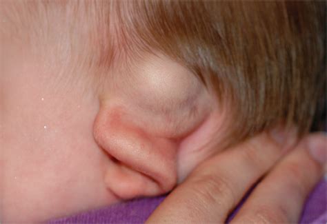 Glial Choristoma Of The Temporal Bone In A 7 Month Old Infant