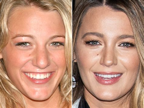 Blake Lively Nose Job Before And After