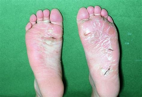 White Spots On Bottom Of Feet Management And Treatment Options For