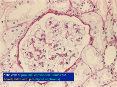 Glomerulus And Nephrotic And Nephritic Syndrome Ppt Powerpoint