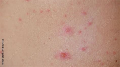 The Classic Symptom Of Chickenpox Is A Rash That Turns Into Itchy