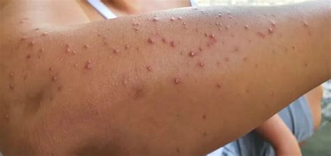 Arm Acne How To Get Rid Of Pimples On Your Arms Riverchase Dermatology