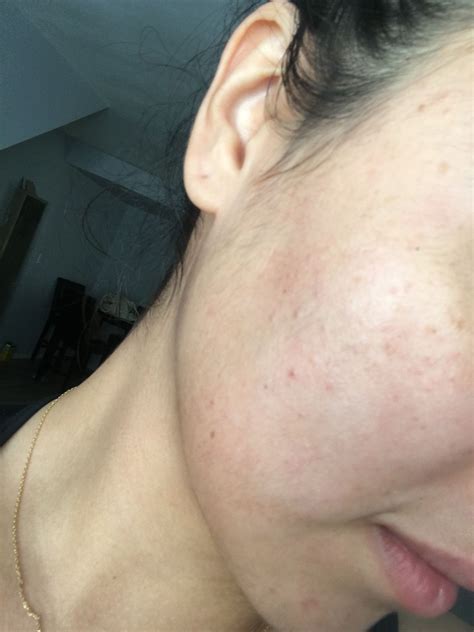 Colorless Bumps On Forehead Cheeks And Beauty Insider Community