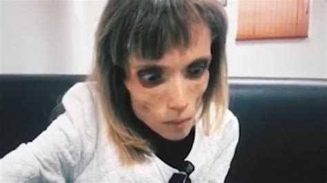 Watch Anorexic Woman Who Weighs Less Than Stone Mocked By Doctors Metro Video