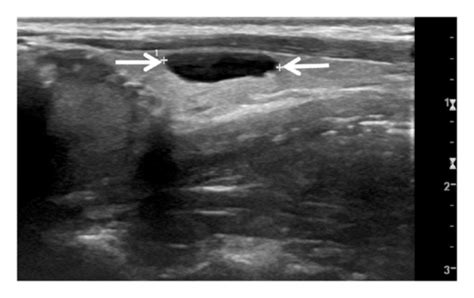 A Thyroid Colloid Cyst With Positive Fluctuation In A 40 Year Old