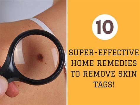 10 super effective home remedies to remove skin tags