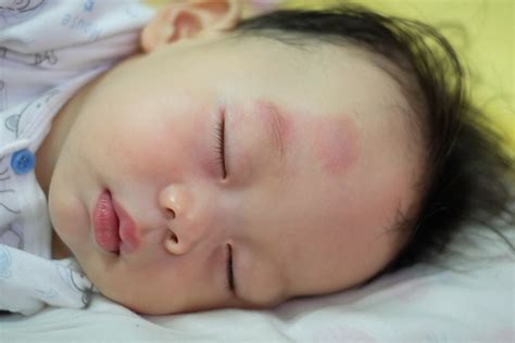 Bruising In Babies Is It Normal Causes And Treatment