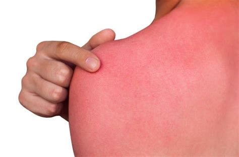 Alergia Al Sol Tipos Síntomas Tratamiento Y Más