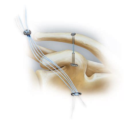 Arthrex Ac Tightrope® Technique