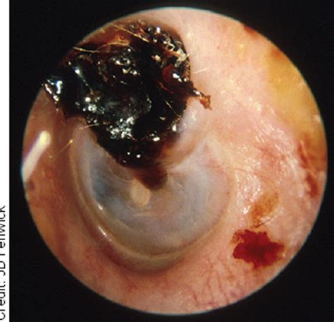 Management Of Patients Presenting With Otorrhoea Diagnostic And