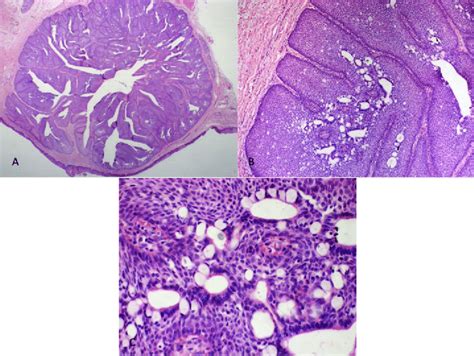 Histopathological Features Of The Oral Inverted Ductal Papilloma A B