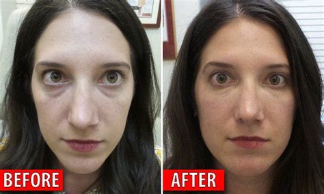 Can A Five Minute Procedure Erase Dark Under Eye Circles On The Spot