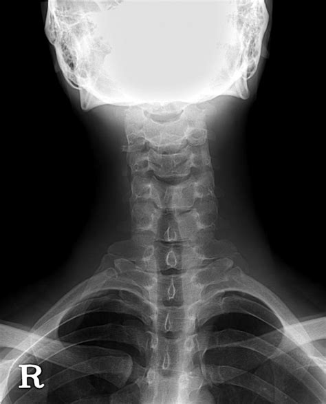 Simple X Ray Shows 21 Years Old Man With Bilateral Cervical Ribs