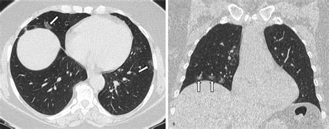 A Axial Ct Image Of The Chest Without Contrast Performed 1 Day After