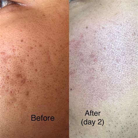 Acne Scars Treatment With Fraxel And Microneedling Albany Laser