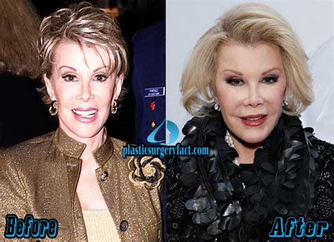 Top 10 Pictures Of Celebrity Plastic Surgery Gone Wrong