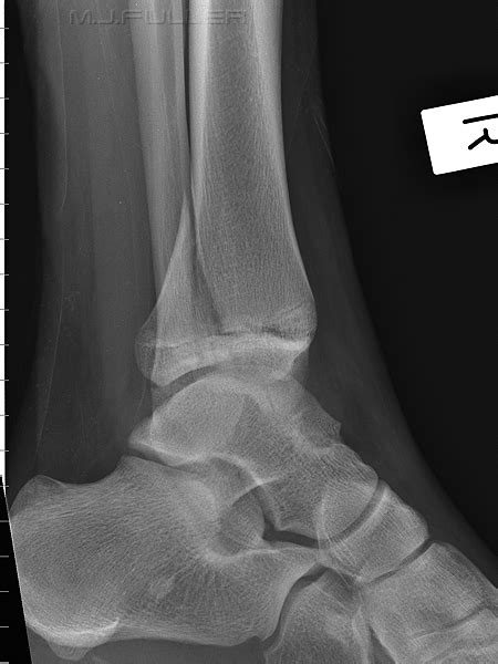 Ankle Trauma 3 Wikiradiography