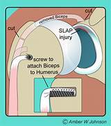 Photos of Recovery From Biceps Tenodesis Arthroscopy Surgery