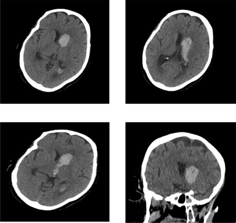 Axial Non Contrast Brain Computed Tomography Demonstrating A Large