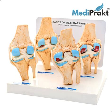 Mediprakt Knee Joint Arthritis Model 4 Stage Osteoarthritis For Demonstration And Orthopedic