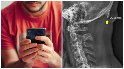 Excessive Smartphone Usage Promotes The Growth Of Horn Like Bones In