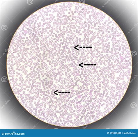 Blood Smear Leishman Stained Microscopic Anemia Stock Photo Image Of